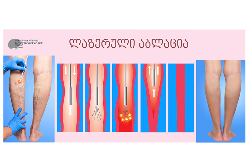 A lábízület boka artrózisa. Arthrózis (porckopás) tünetei és kezelése
